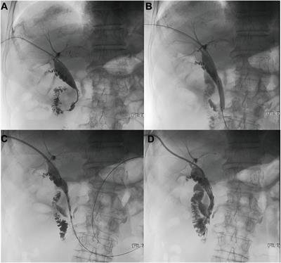 Sarcopenia increases the risk of early biliary infection after percutaneous transhepatic biliary stent placement